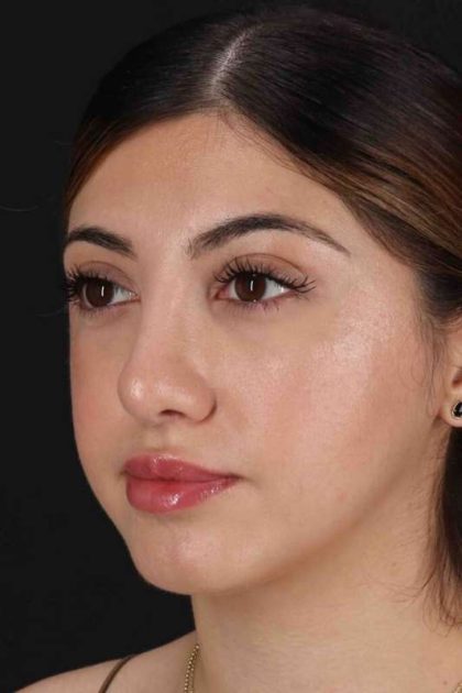 Rhinoplasty Before & After Patient #3214