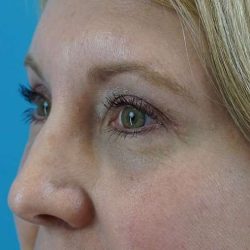 Browlift Before & After Patient #1402
