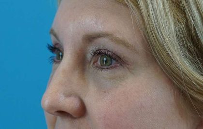 Browlift Before & After Patient #1402