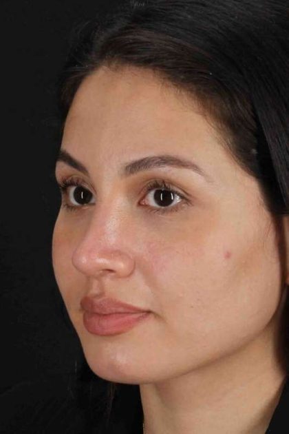 Rhinoplasty Before & After Patient #3236