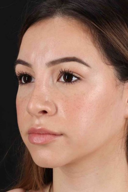 Rhinoplasty Before & After Patient #3247