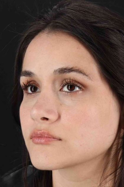 Rhinoplasty Before & After Patient #3258