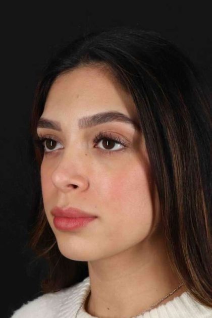 Rhinoplasty Before & After Patient #3269