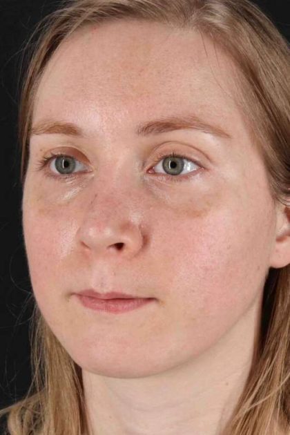 Rhinoplasty Before & After Patient #3280