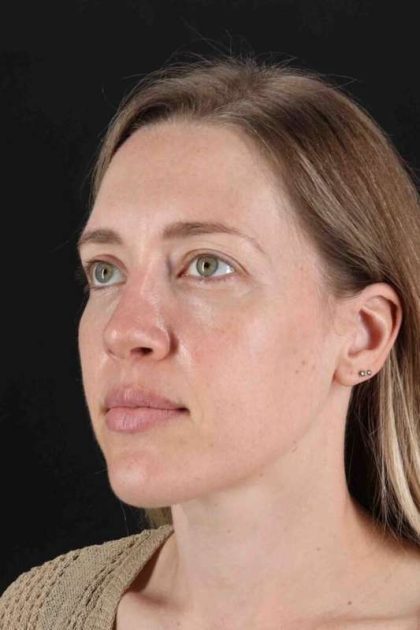 Rhinoplasty Before & After Patient #3291