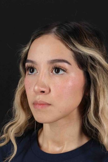 Rhinoplasty Before & After Patient #3302