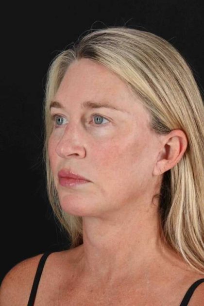 Upper Blepharoplasty Before & After Patient #3434