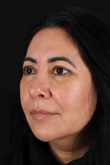 Upper Blepharoplasty Before & After Patient #3456