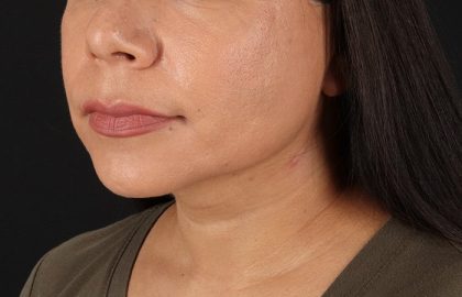 Facelift Before & After Patient #3555