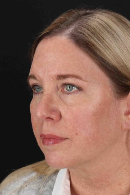 Rhinoplasty Before & After Patient #3566