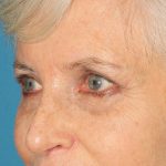 Lower Blepharoplasty Before & After Patient #2419
