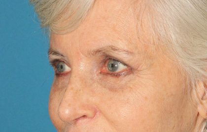 Upper Blepharoplasty Before & After Patient #3532