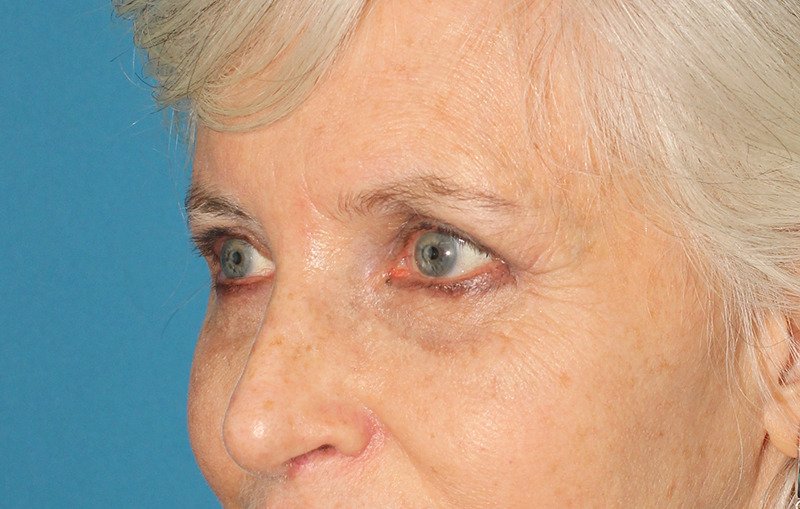 Upper Blepharoplasty Before & After Patient #3532