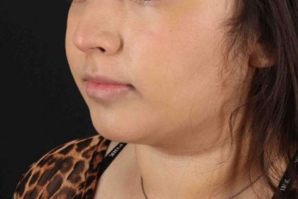 Buccal Fat Pad Before & After Patient #1469