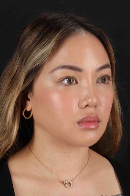 Chin Implant Before & After Patient #1507