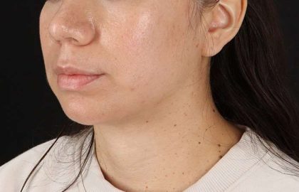 Chin Implant Before & After Patient #1540