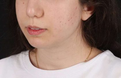 Chin Implant Before & After Patient #1551
