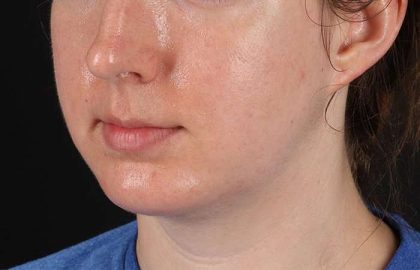 Chin Implant Before & After Patient #1562