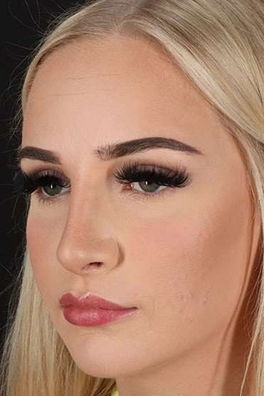 Browlift Before & After Patient #1242