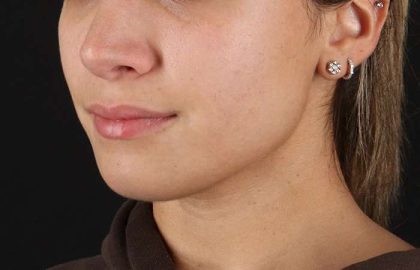 Chin Implant Before & After Patient #1573