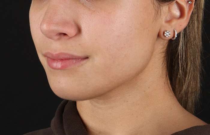 Chin Implant Before & After Patient #1573