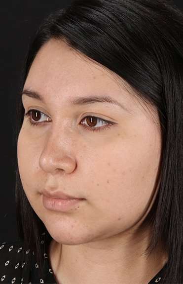 Chin Implant Before & After Patient #1604