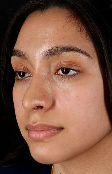 Chin Implant Before & After Patient #1637