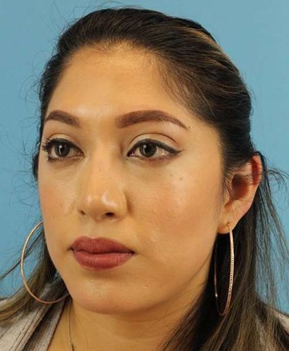 Chin Implant Before & After Patient #1670