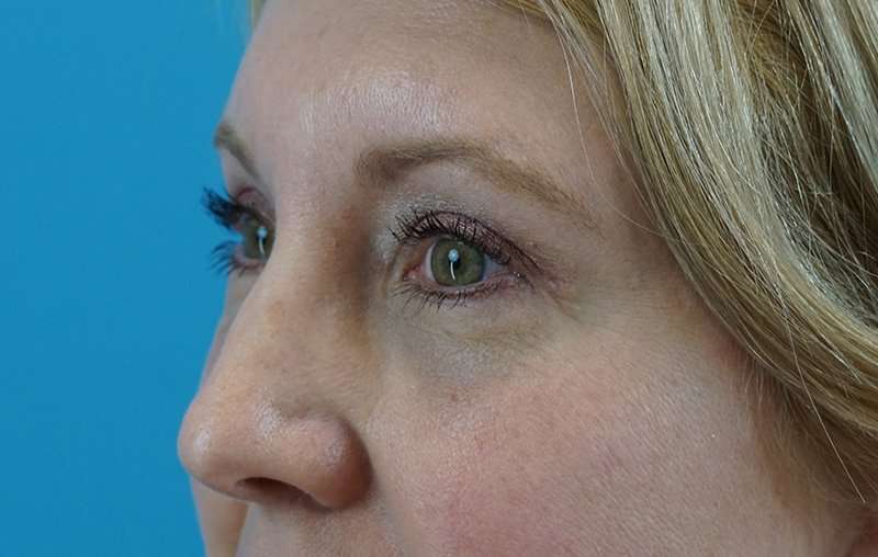 Eyelid Lift Before & After Patient #1747