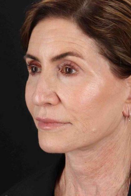 Facelift Before & After Patient #1789