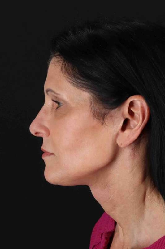 Facelift Before & After Patient #1854