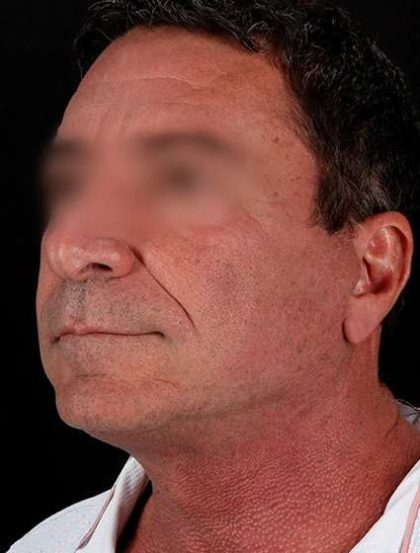 Facelift Before & After Patient #1899