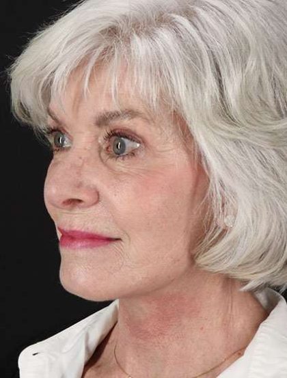 Facelift Before & After Patient #1932
