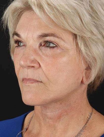 Facelift Before & After Patient #1943