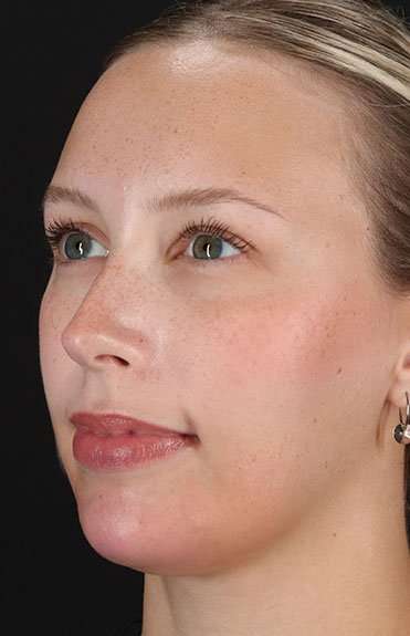 Fillers Before & After Patient #2030
