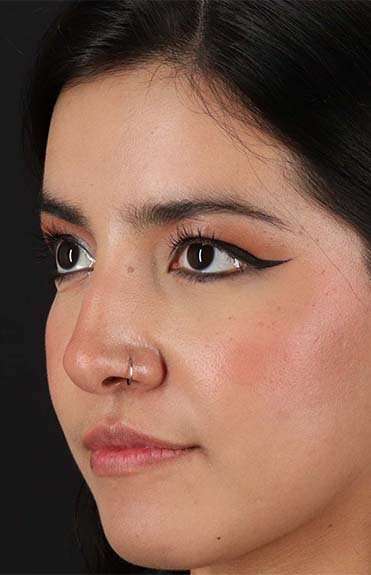 Fillers Before & After Patient #2041