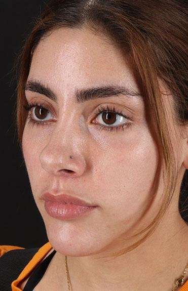 Fillers Before & After Patient #2052