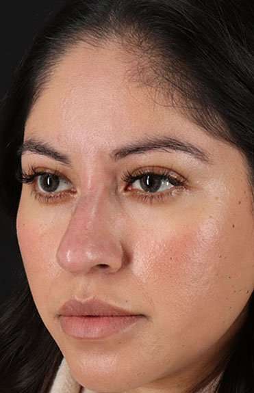 Fillers Before & After Patient #2063