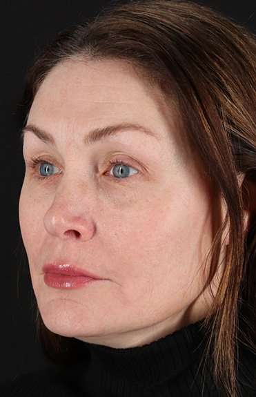Lip Lift Before & After Patient #2144