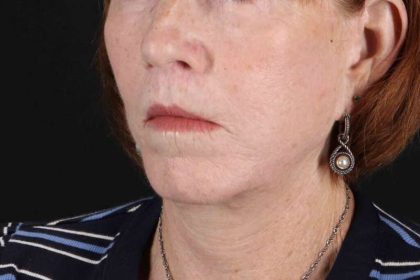 Lip Lift Before & After Patient #2155