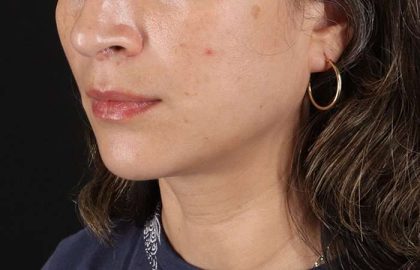 Lip Lift Before & After Patient #2166