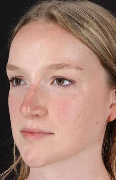 Liquid Rhinoplasty Before & After Patient #2177