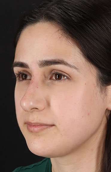 Liquid Rhinoplasty Before & After Patient #2188