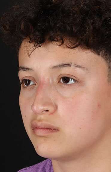 Liquid Rhinoplasty Before & After Patient #2199