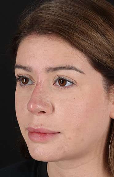 Liquid Rhinoplasty Before & After Patient #2210
