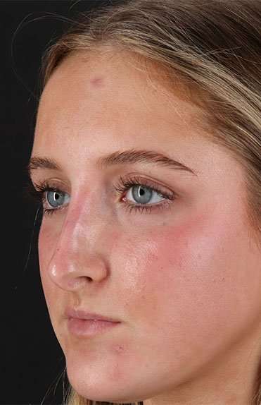 Liquid Rhinoplasty Before & After Patient #2221