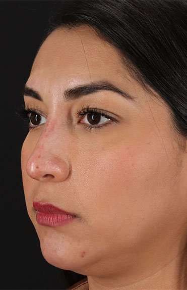 Liquid Rhinoplasty Before & After Patient #2232