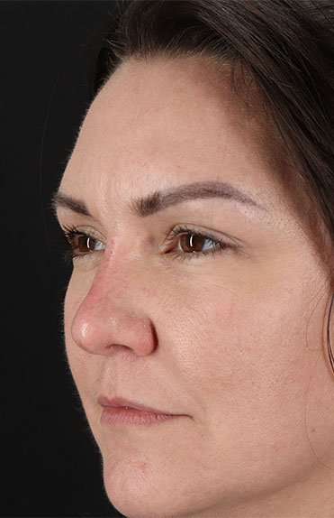 Liquid Rhinoplasty Before & After Patient #2243