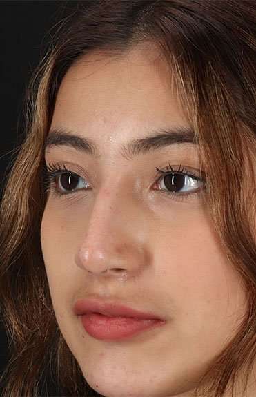 Liquid Rhinoplasty Before & After Patient #2254
