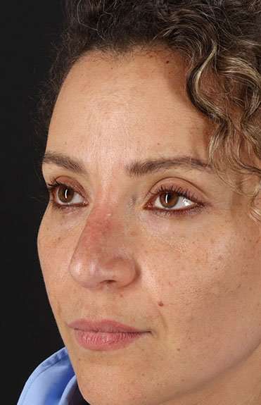 Liquid Rhinoplasty Before & After Patient #2276
